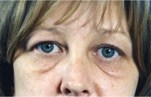 Eye lift blepharoplasty before results Case 2115 – Feng Clinic Cleveland OH