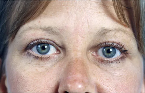 Eye lift blepharoplasty after results Case 2115 – Feng Clinic Cleveland OH
