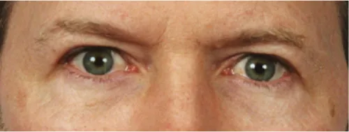 Eye lift blepharoplasty before results Case 2118 – Feng Clinic Cleveland OH