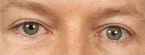 Eye lift blepharoplasty after results Case 2118 – Feng Clinic Cleveland OH