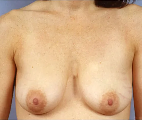 Breast lift mastopexy before results Case 3 – Feng Clinic Cleveland OH
