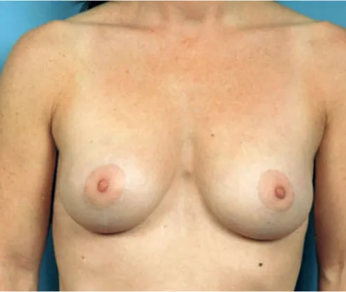 Breast lift mastopexy after results Case 3 – Feng Clinic Cleveland OH