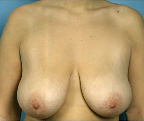 Breast reduction surgery before results – Feng Clinic Cleveland OH