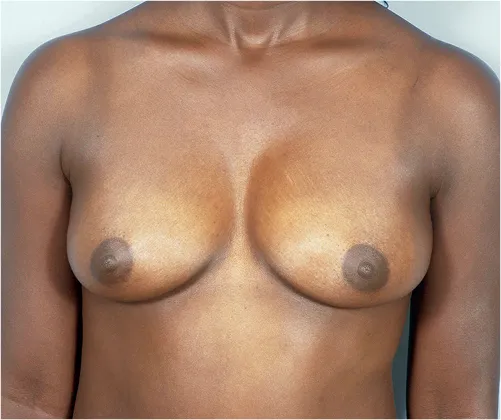 Natural breast enhancement fat grafting after results Case 1 – Feng Clinic Cleveland OH