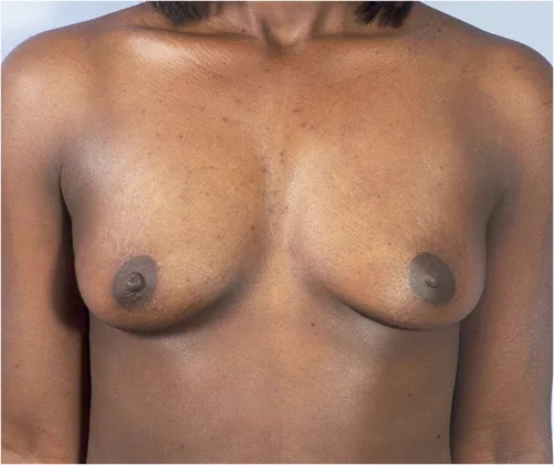 Natural breast enhancement fat grafting before results Case 1 – Feng Clinic Cleveland OH