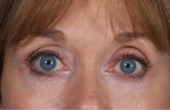 Eye lift blepharoplasty after results Case 2109 – Feng Clinic Cleveland OH