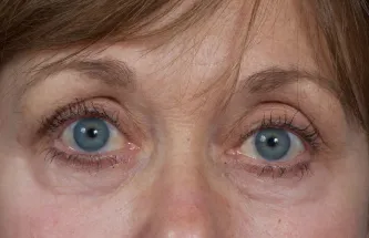 Eye lift blepharoplasty before results Case 2109 – Feng Clinic Cleveland OH