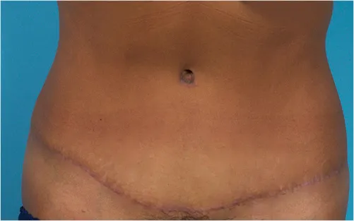 Painless abdominoplasty tummy tuck after results Case 4 – Feng Clinic Cleveland OH