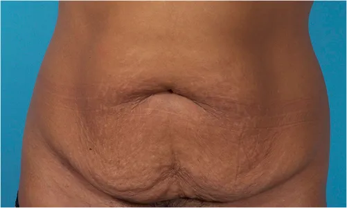 Painless abdominoplasty tummy tuck before results Case 4 – Feng Clinic Cleveland OH