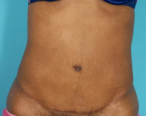 Painless abdominoplasty tummy tuck after results Case 3 – Feng Clinic Cleveland OH