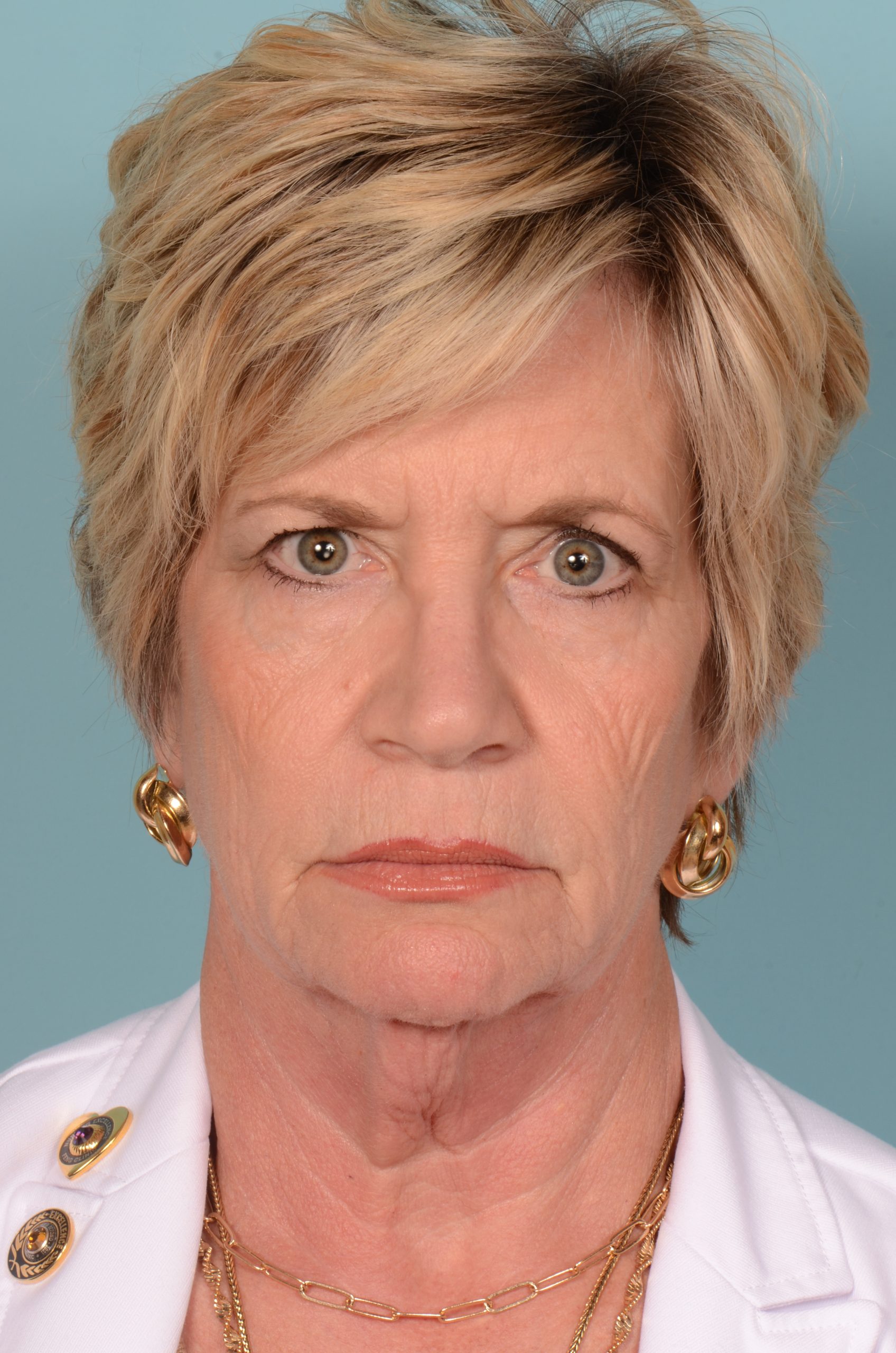 Facelift before results Case 5991 – Feng Clinic Cleveland OH