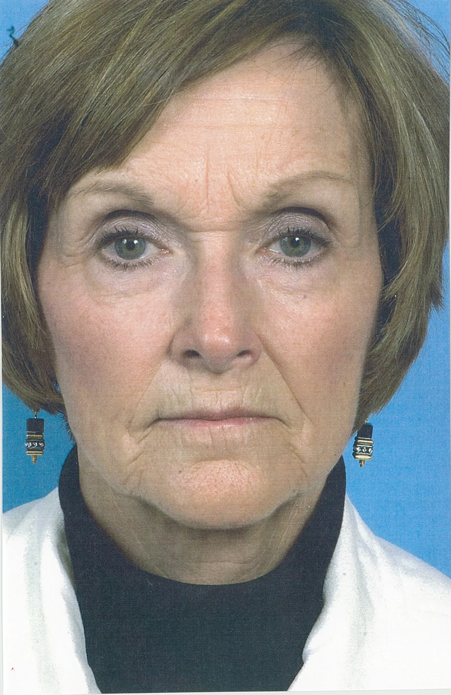 Before: Facelift before results Case 5990 – Feng Clinic Cleveland OH