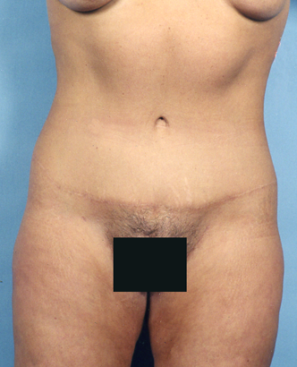 Painless abdominoplasty tummy tuck after results Case 1 – Feng Clinic Cleveland OH