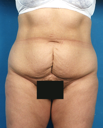 Painless abdominoplasty tummy tuck before results Case 1 – Feng Clinic Cleveland OH