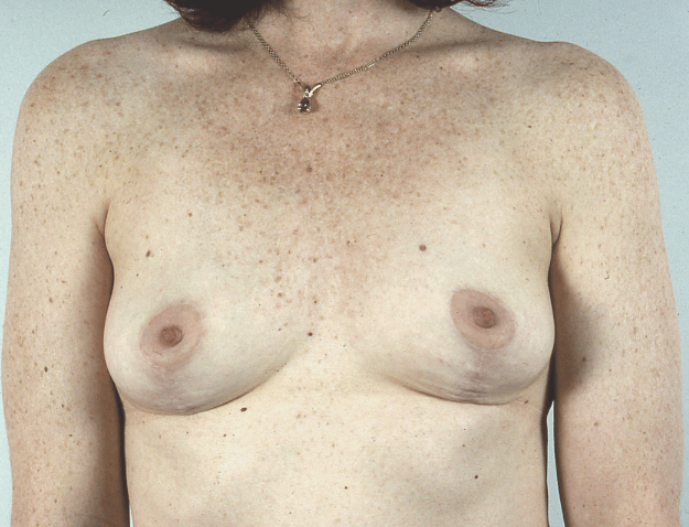 Breast implant capsule removal explant after results Case 2 – Feng Clinic Cleveland OH