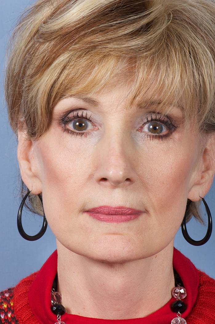 Facelift after results Case 2088– Feng Clinic Cleveland OH