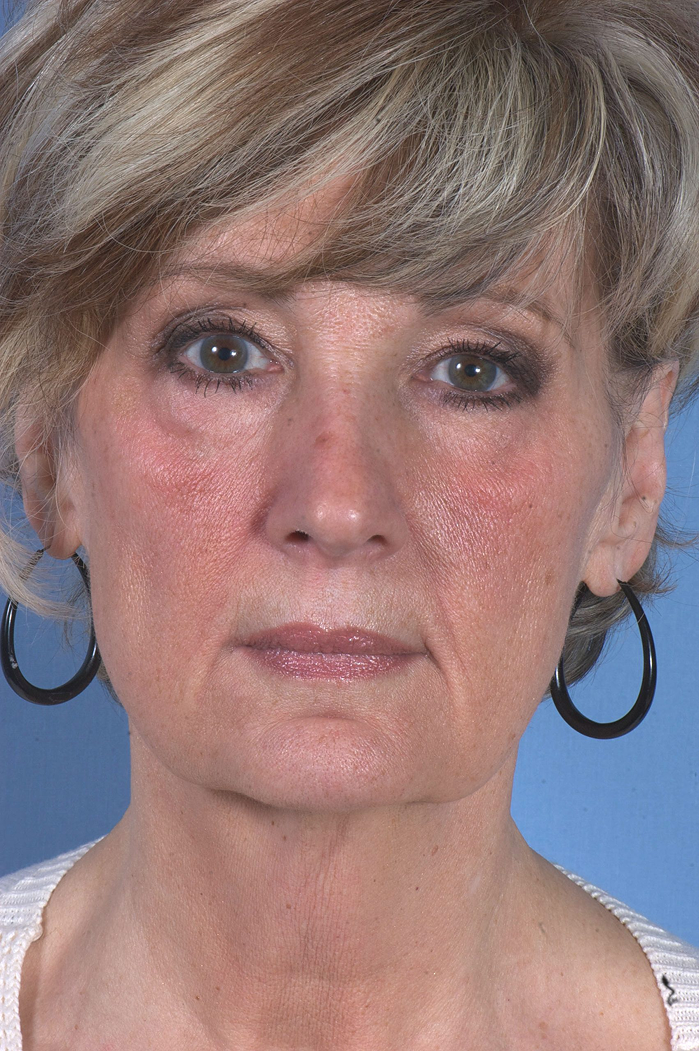 Facelift before results Case 2088 – Feng Clinic Cleveland OH